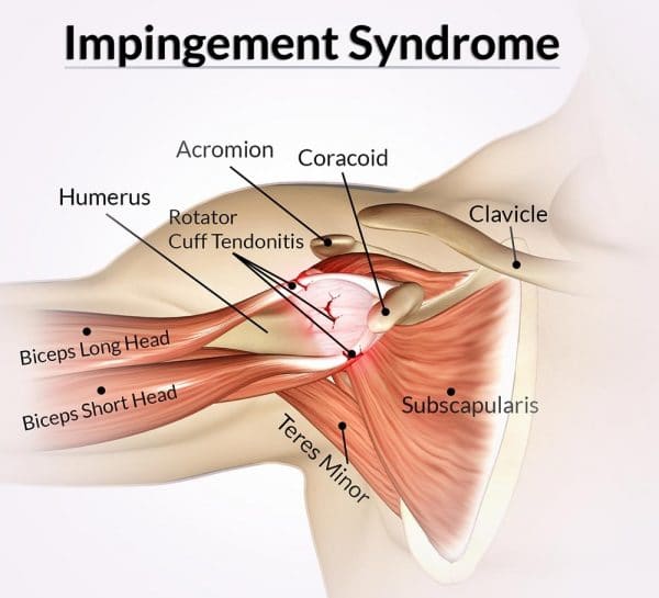 Shoulder Impingement Syndrome