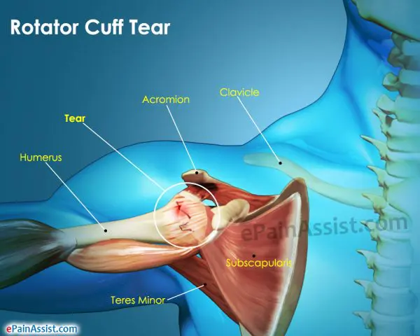 Rotator Cuff Tear